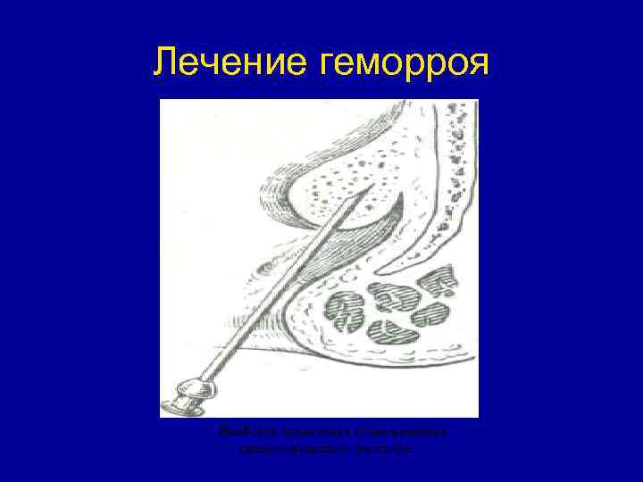 Лечение геморроя . Наиболее правильная точка введения склерозирующего раствора. 