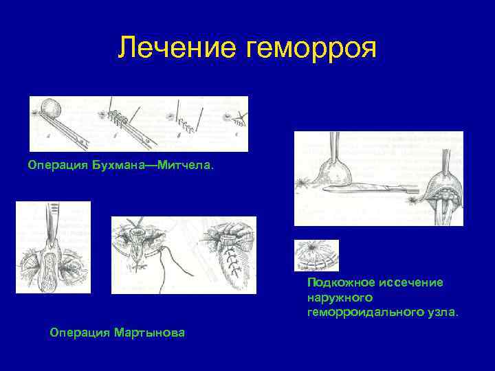 Операция узел