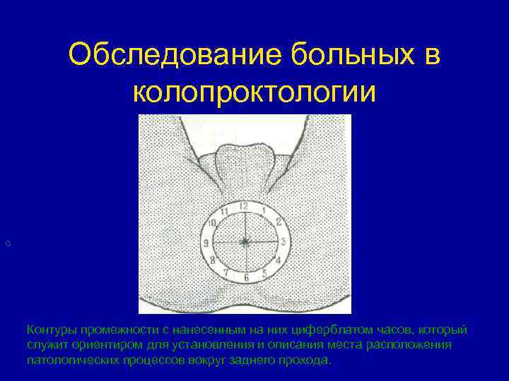 Обследование больных в колопроктологии С Контуры промежности с нанесенным на них циферблатом часов, который