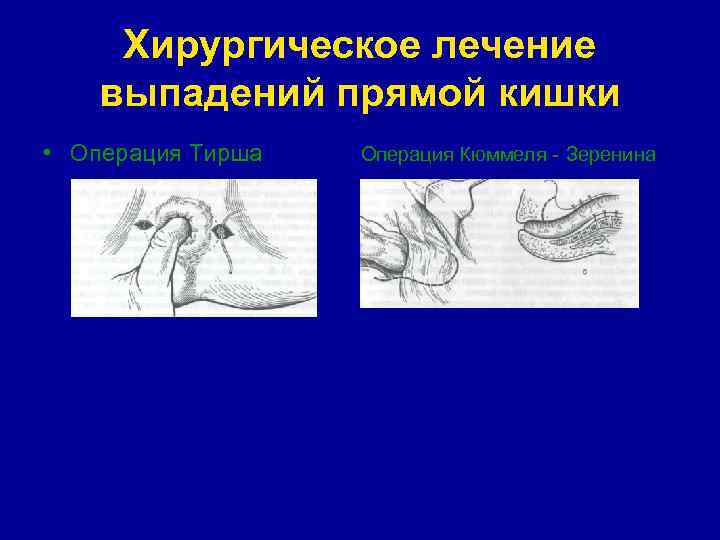 Стадии выпадения прямой кишки