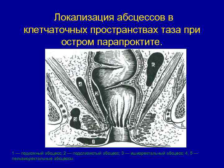 Локализация абсцессов в клетчаточных пространствах таза при остром парапроктите. 1 — подкожный абсцесс; 2