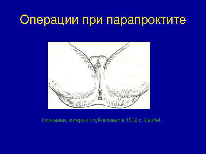 Операции при парапроктите Операция, которую опубликовал в 1932 г. Gabriel. 