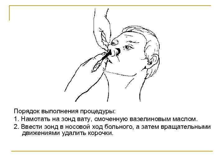 Порядок выполнения процедуры: 1. Намотать на зонд вату, смоченную вазелиновым маслом. 2. Ввести зонд