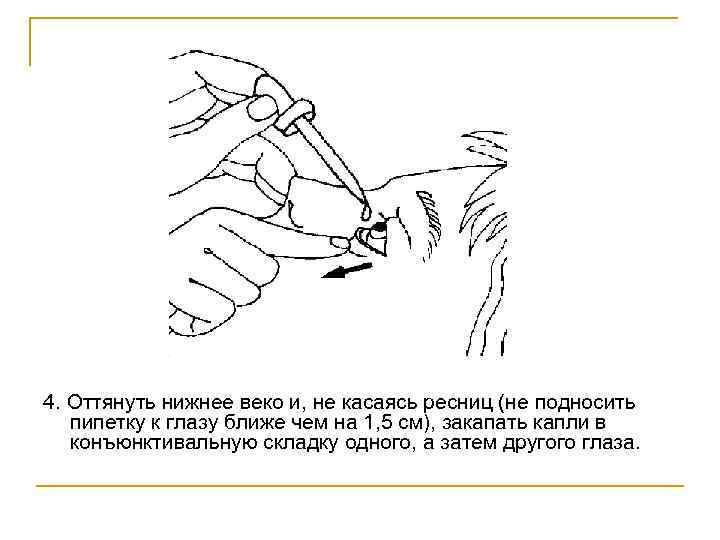 4. Оттянуть нижнее веко и, не касаясь ресниц (не подносить пипетку к глазу ближе