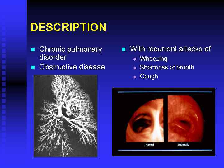 DESCRIPTION n n Chronic pulmonary disorder Obstructive disease n With recurrent attacks of u