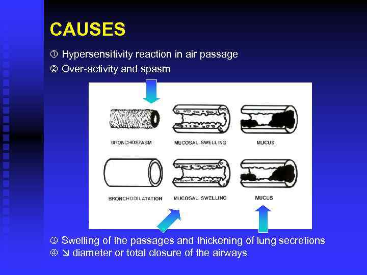 CAUSES Hypersensitivity reaction in air passage Over-activity and spasm Swelling of the passages and