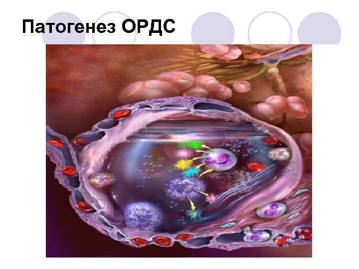 Патогенез ОРДС 