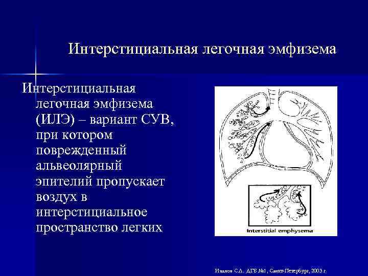 Интерстициальная легочная эмфизема (ИЛЭ) – вариант СУВ, при котором поврежденный альвеолярный эпителий пропускает воздух