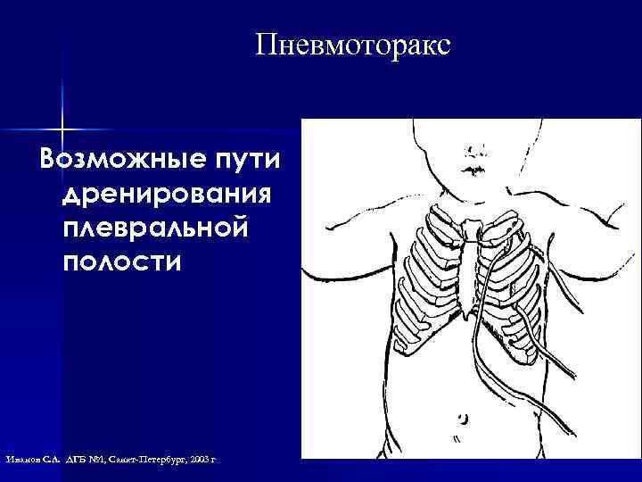 Пневмоторакс Возможные пути дренирования плевральной полости Иванов С. Л. ДГБ № 1, Санкт-Петербург, 2003
