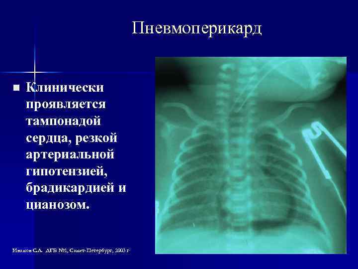 Пневмоперикард n Клинически проявляется тампонадой сердца, резкой артериальной гипотензией, брадикардией и цианозом. Иванов С.