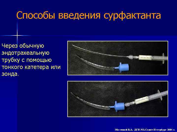 Способы введения сурфактанта Через обычную эндотрахеальную трубку с помощью тонкого катетера или зонда Мостовой