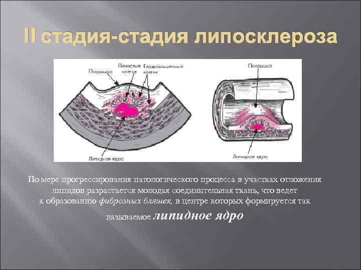 II стадия-стадия липосклероза По мере прогрессирования патологического процесса в участках отложения липидов разрастается молодая