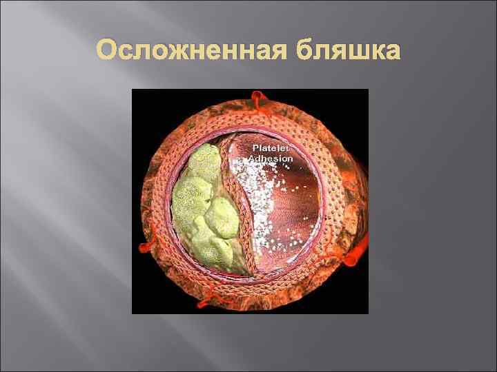 Осложненная бляшка 