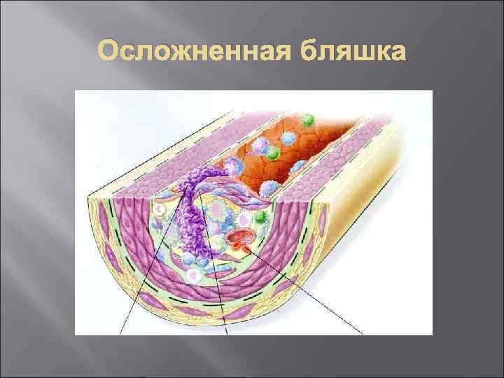Осложненная бляшка 