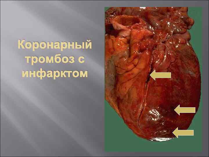 Коронарный тромбоз с инфарктом 