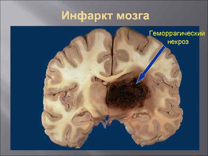 Инфаркт мозга Геморрагический некроз 