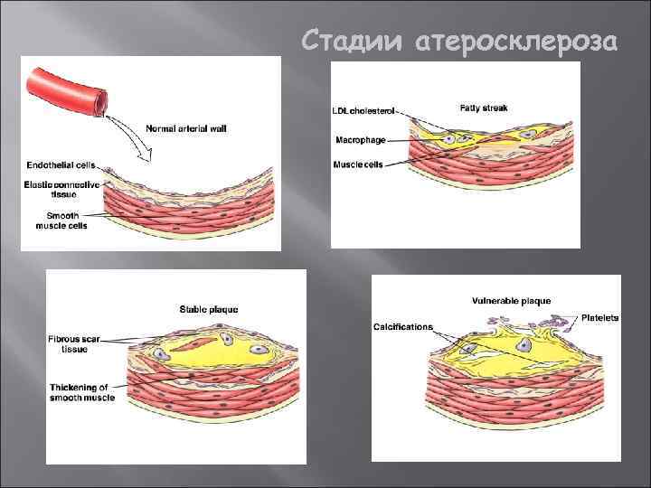 Стадии атеросклероза 