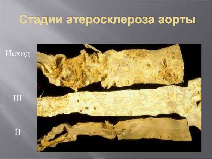 Стадии атеросклероза аорты Исход III II 