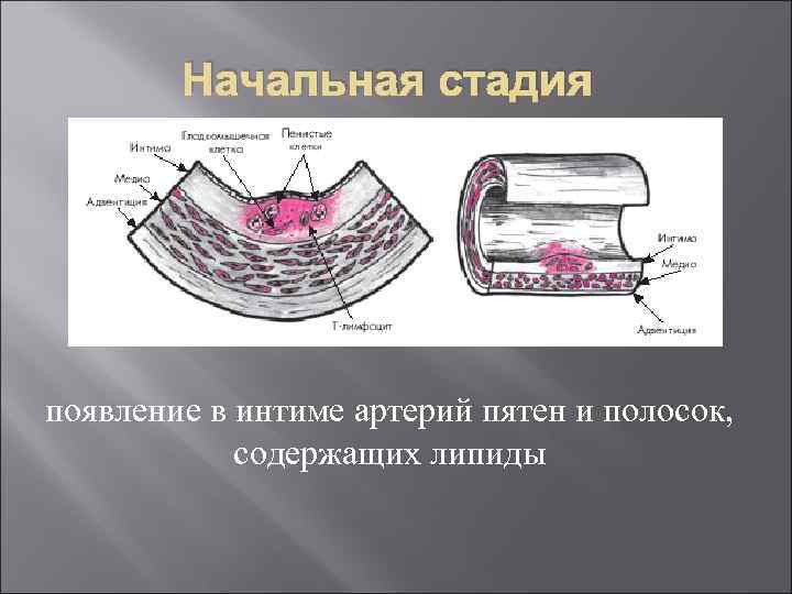 Начальная стадия появление в интиме артерий пятен и полосок, содержащих липиды 