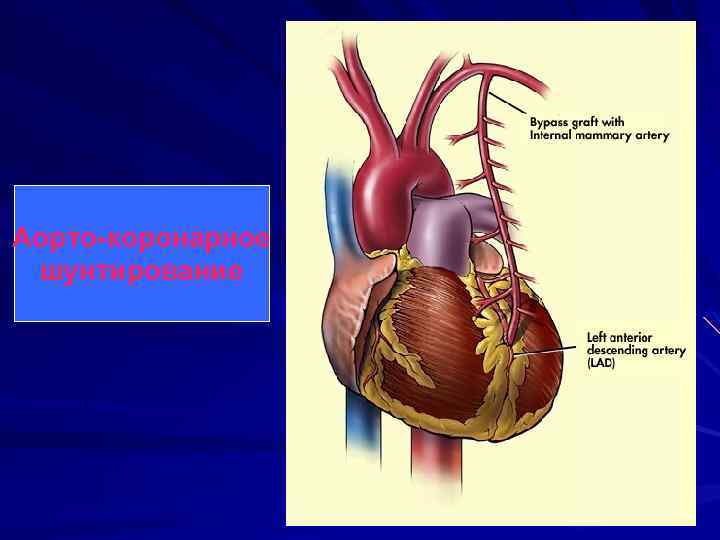 Аорто-коронарное шунтирование 