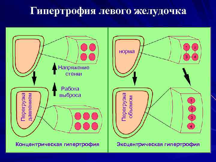 Гипертрофия левого желудочка норма Работа выброса Концентрическая гипертрофия Перегрузка объемом Перегрузка давлением Напряжение стенки