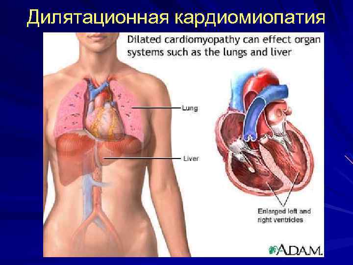 Дилятационная кардиомиопатия 