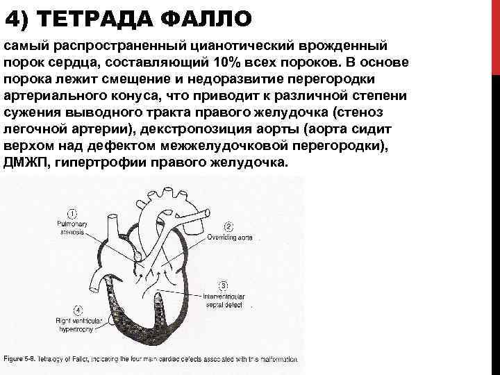 4) ТЕТРАДА ФАЛЛО самый распространенный цианотический врожденный порок сердца, составляющий 10% всех пороков. В