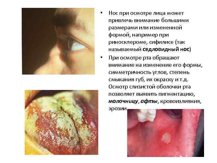 • Нос при осмотре лица может привлечь внимание большими размерами или измененной формой,