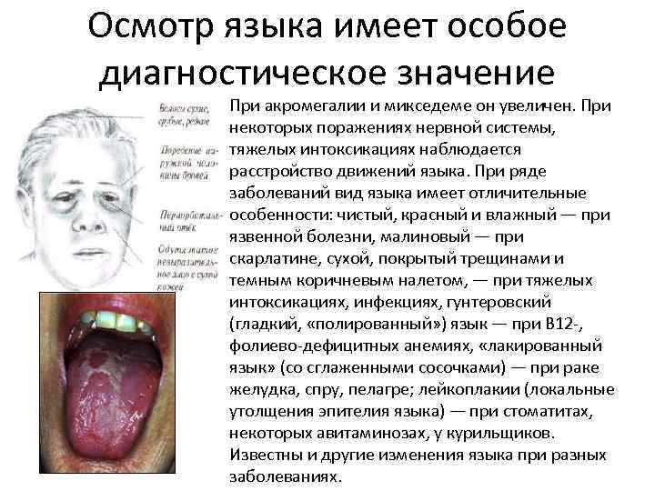 Осмотр языка имеет особое диагностическое значение • При акромегалии и микседеме он увеличен. При