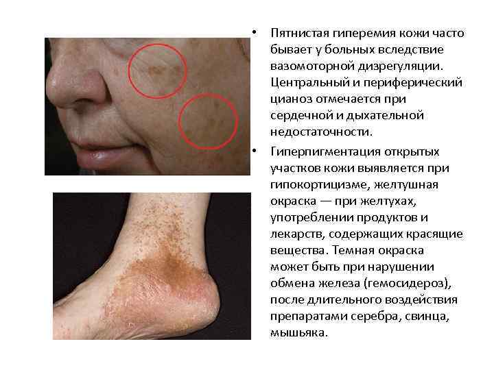  • Пятнистая гиперемия кожи часто бывает у больных вследствие вазомоторной дизрегуляции. Центральный и
