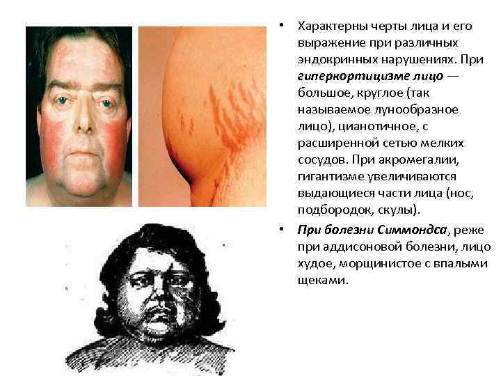  • Характерны черты лица и его выражение при различных эндокринных нарушениях. При гиперкортицизме