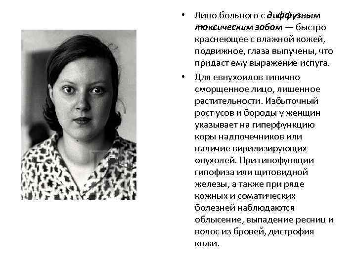  • Лицо больного с диффузным токсическим зобом — быстро краснеющее с влажной кожей,