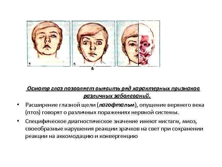 Для клинической картины лагофтальма характерно все кроме