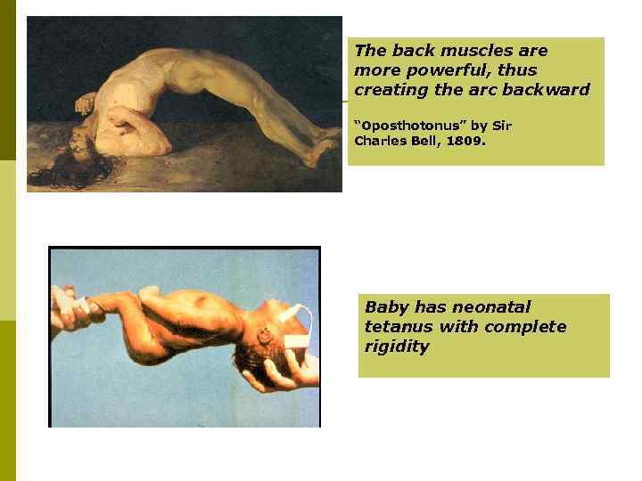 The back muscles are more powerful, thus creating the arc backward “Oposthotonus” by Sir