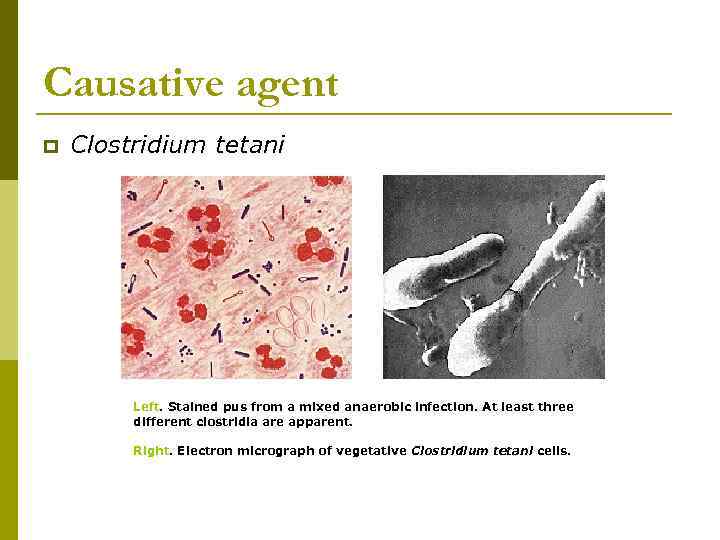 Causative agent p Clostridium tetani Left. Stained pus from a mixed anaerobic infection. At
