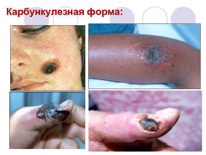 Карбункулезная форма: 