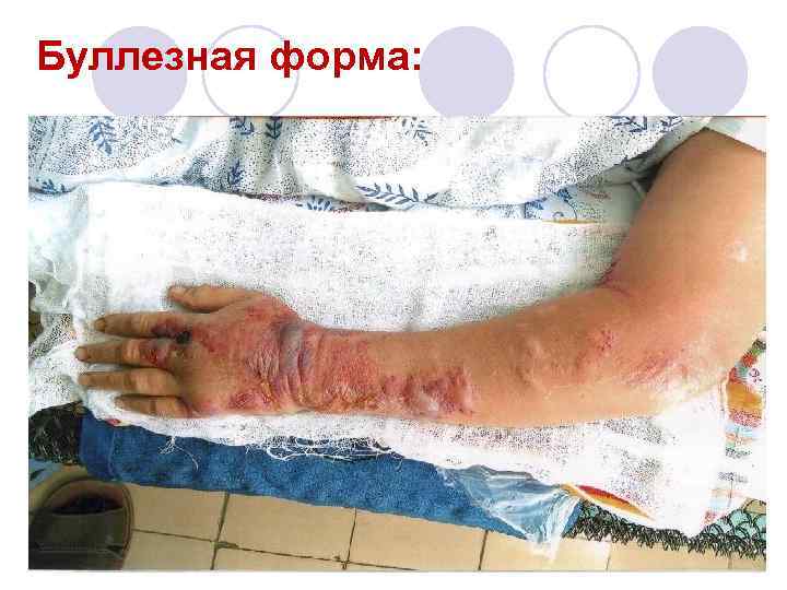Буллезная форма: 