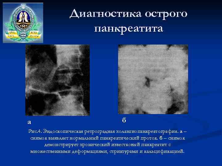 Диагностика острого панкреатита а б Рис. 4. Эндоскопическая ретроградная холангиопанкреатография. а – снимок выявляет