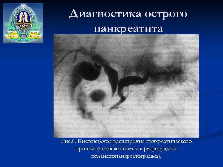 Диагностика острого панкреатита Рис. 6. Кистовидное расширение панкреатического протока (эндоскопическая ретроградная холангиопанкреатограмма). 