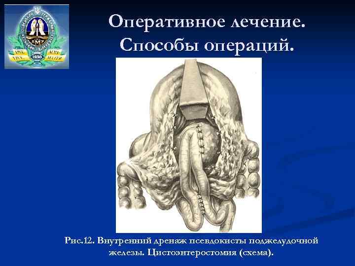 Оперативное лечение. Способы операций. Рис. 12. Внутренний дренаж псевдокисты поджелудочной железы. Цистоэнтеростомия (схема). 