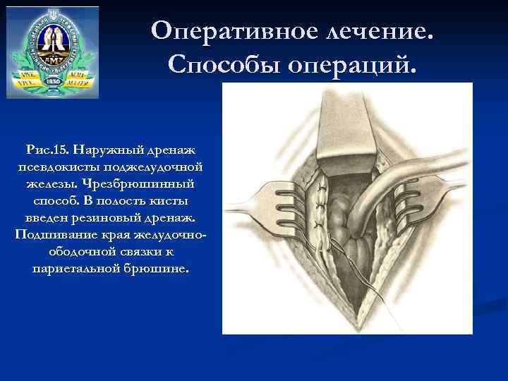Оперативное лечение. Способы операций. Рис. 15. Наружный дренаж псевдокисты поджелудочной железы. Чрезбрюшинный способ. В