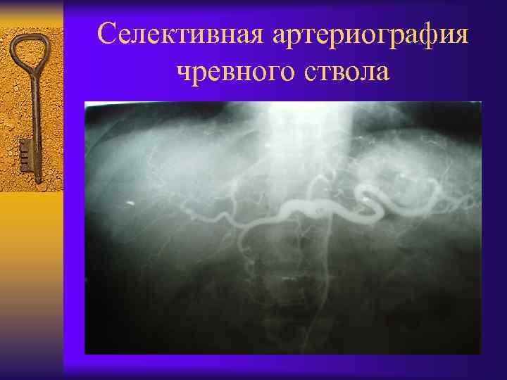 Селективная артериография чревного ствола 