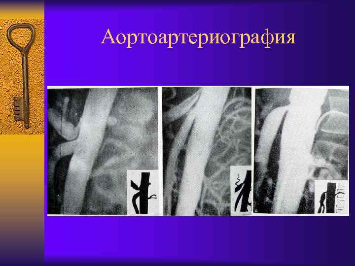Аортоартериография 