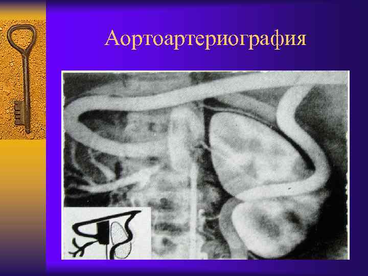 Аортоартериография 