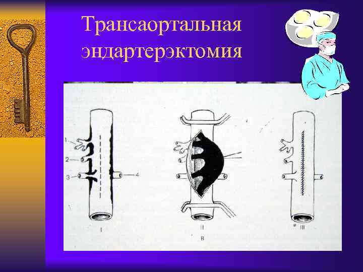 Трансаортальная эндартерэктомия 