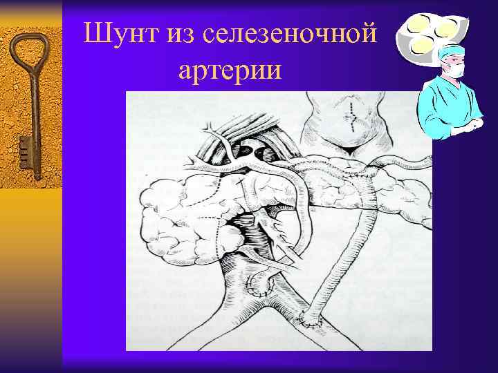 Шунт из селезеночной артерии 