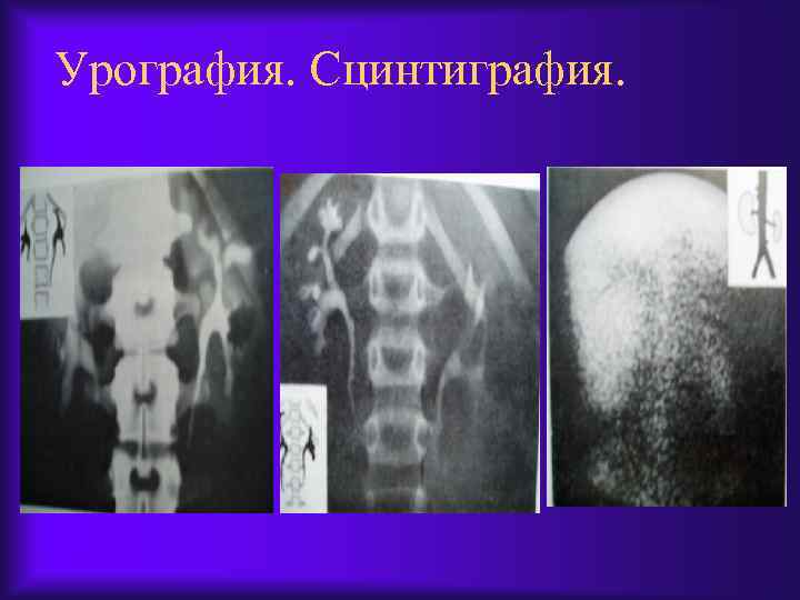 Урография. Сцинтиграфия. 