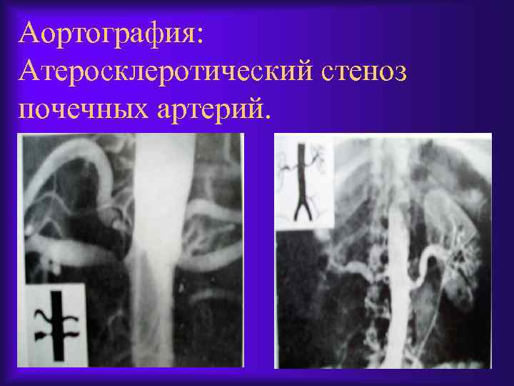 Аортография: Атеросклеротический стеноз почечных артерий. 