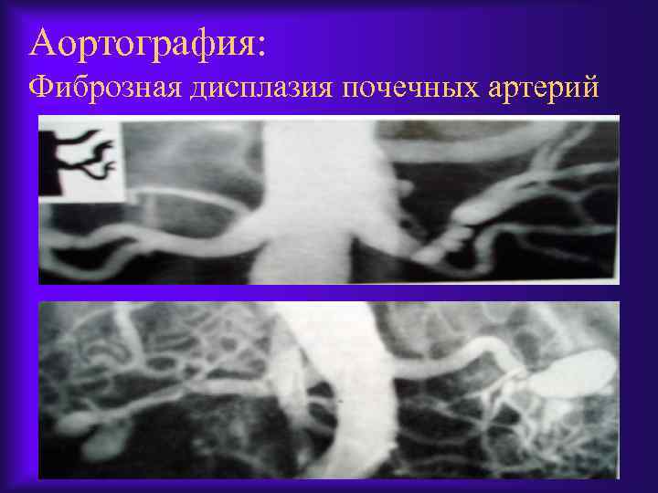 Аортография: Фиброзная дисплазия почечных артерий 