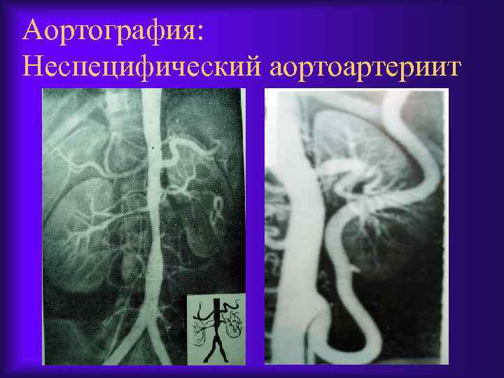 Аортография: Неспецифический аортоартериит 